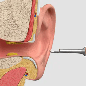 Nettoyeur oreilles avec caméra
